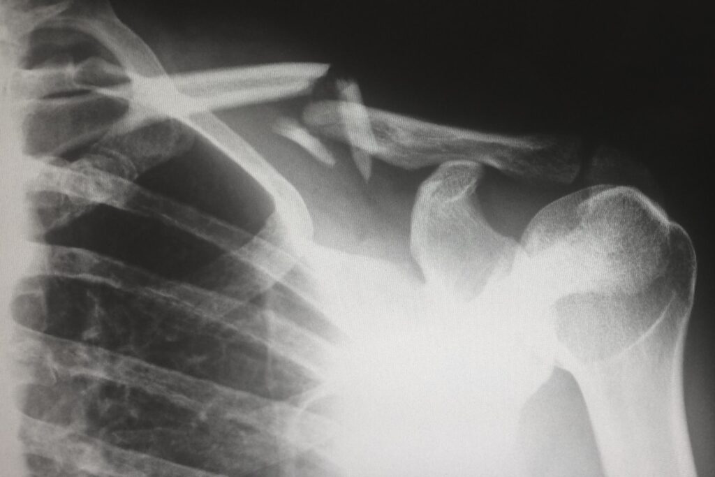 X-Ray