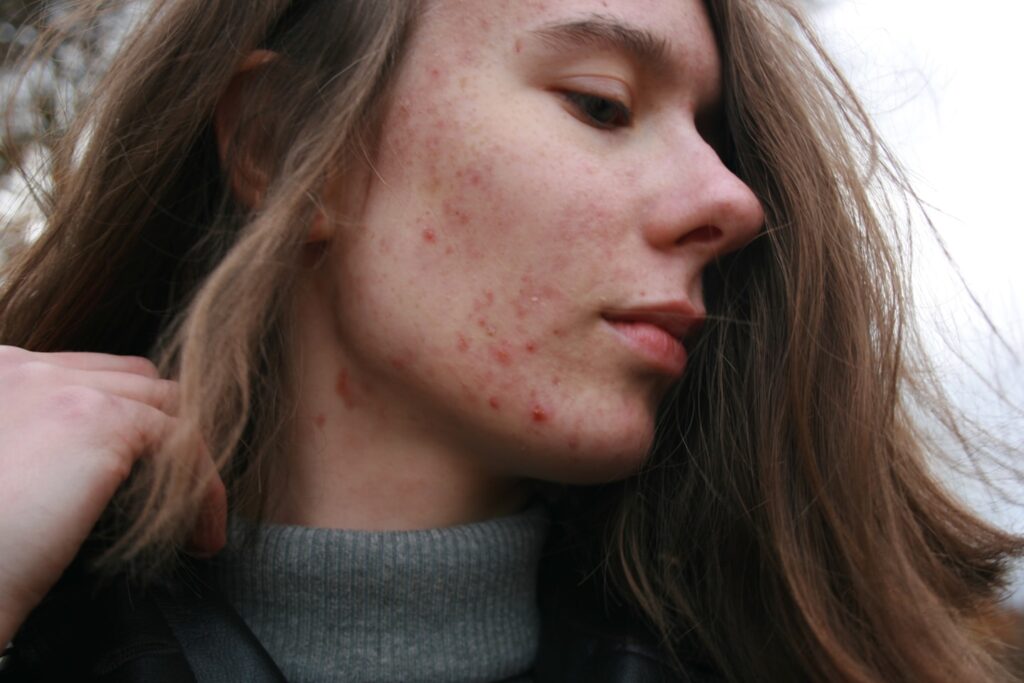 Short story short... Picture I took a day before starting next dermatological treatment to remind myself, how strong I could be regardless of my looks. People vs stereotypes!