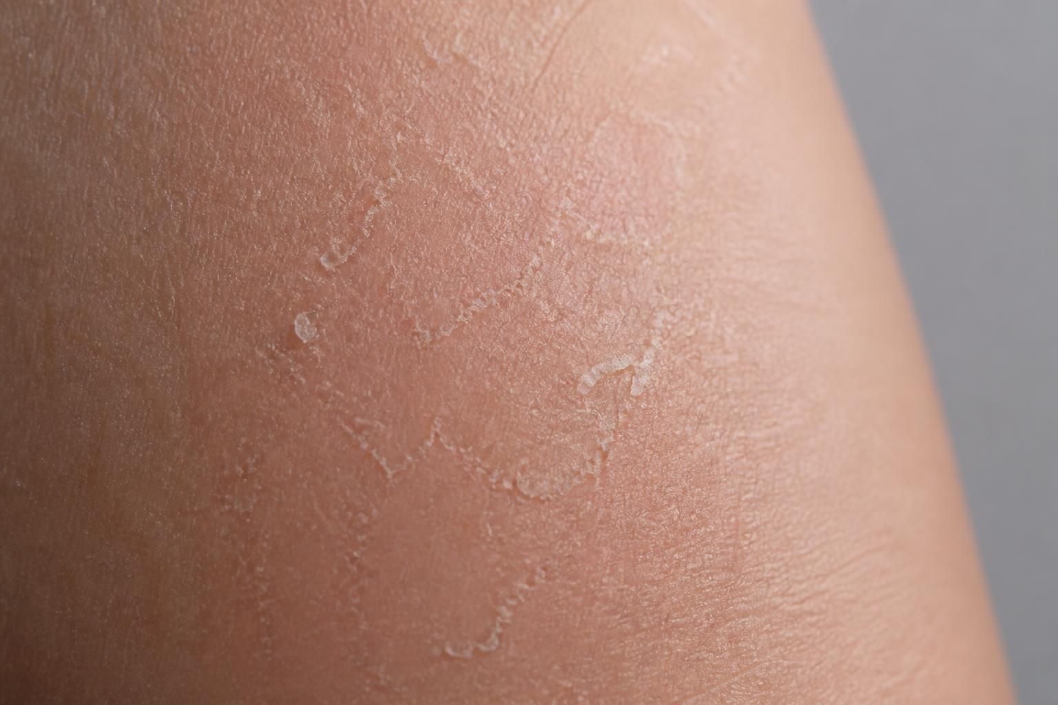 découvrez pourquoi la desquamation naturelle de la peau peut parfois devenir problématique et comment y remédier pour préserver une peau saine et équilibrée.